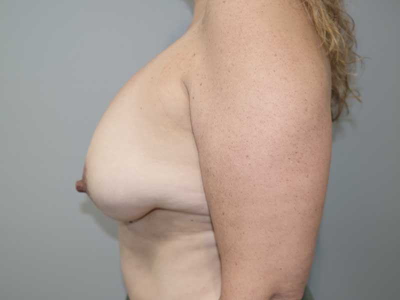 Breast Revision Before and After 16 | Grover Aesthetics