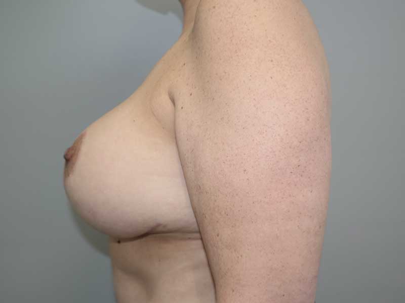 Breast Revision Before and After 16 | Grover Aesthetics