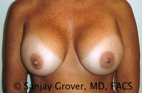 Breast Revision Before and After 49 | Sanjay Grover MD FACS
