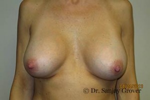 Breast Revision Before and After | Sanjay Grover MD FACS