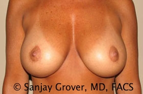 Breast Revision Before and After | Grover Aesthetics