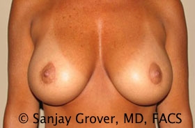 Breast Revision Before and After | Sanjay Grover MD FACS