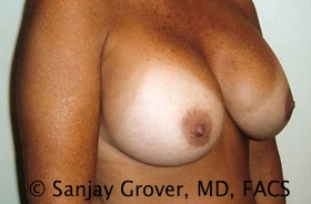 Breast Revision Before and After 22 | Grover Aesthetics