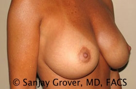 Breast Revision Before and After 22 | Grover Aesthetics
