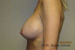 Breast Revision Before and After 23 | Grover Aesthetics