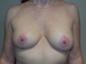 Breast Revision Before and After | Grover Aesthetics