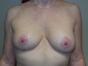 Breast Revision Before and After | Sanjay Grover MD FACS