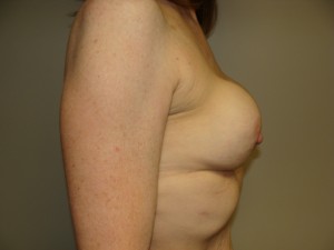 Breast Revision Before and After 25 | Grover Aesthetics