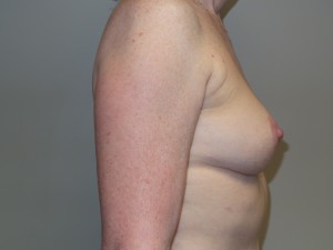 Breast Revision Before and After 25 | Grover Aesthetics