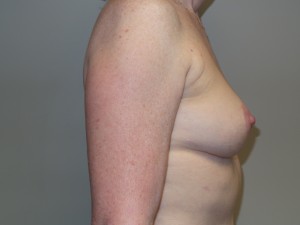 Breast Revision Before and After 25 | Sanjay Grover MD FACS