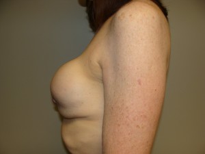 Breast Revision Before and After 25 | Grover Aesthetics