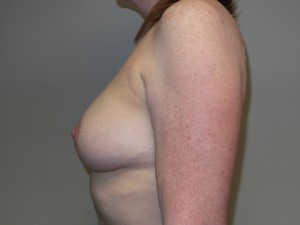 Breast Revision Before and After 25 | Grover Aesthetics