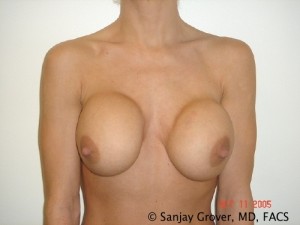Breast Revision Before and After | Grover Aesthetics