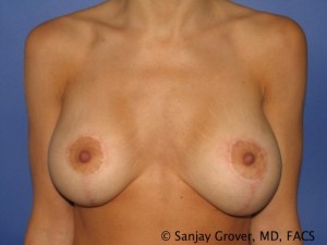 Breast Revision Before and After | Grover Aesthetics