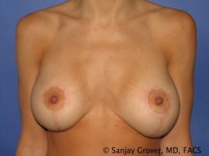 Breast Revision Before and After | Sanjay Grover MD FACS