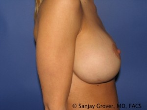 Breast Revision Before and After 29 | Grover Aesthetics
