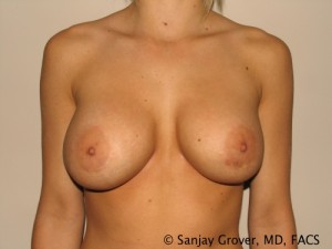 Breast Revision Before and After 27 | Sanjay Grover MD FACS