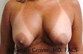 Breast Revision Before and After 33 | Sanjay Grover MD FACS