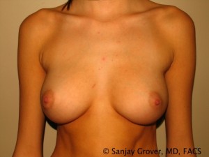 Breast Revision Before and After | Grover Aesthetics