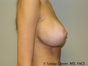 Breast Revision Before and After 31 | Grover Aesthetics
