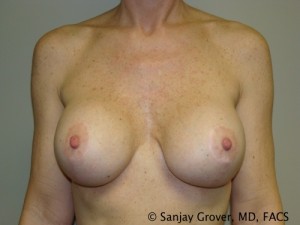 Breast Revision Before and After | Grover Aesthetics
