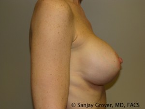 Breast Revision Before and After 32 | Grover Aesthetics