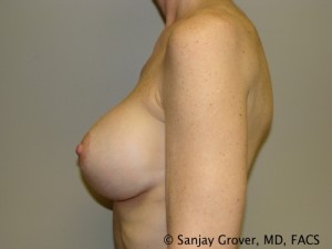 Breast Revision Before and After 32 | Grover Aesthetics