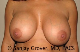 Breast Revision Before and After 02 | Sanjay Grover MD FACS