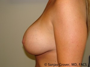 Breast Revision Before and After 33 | Sanjay Grover MD FACS