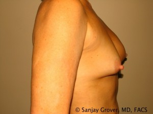 Breast Revision Before and After 34 | Grover Aesthetics
