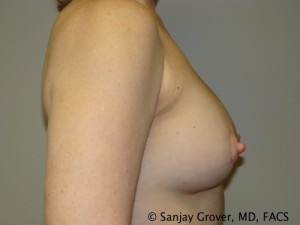 Breast Revision Before and After 34 | Grover Aesthetics