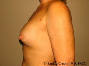 Breast Revision Before and After 34 | Grover Aesthetics