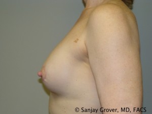 Breast Revision Before and After 34 | Grover Aesthetics