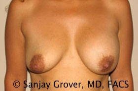 Breast Revision Before and After 04 | Sanjay Grover MD FACS
