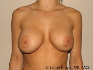 Breast Revision Before and After | Grover Aesthetics