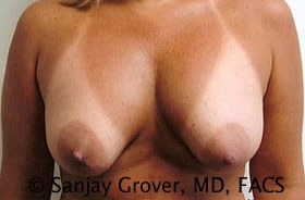 Breast Revision Before and After | Grover Aesthetics