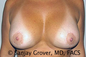 Breast Revision Before and After | Grover Aesthetics