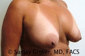 Breast Revision Before and After 36 | Grover Aesthetics