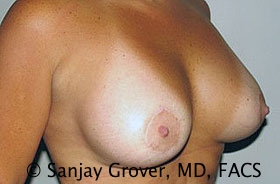Breast Revision Before and After 36 | Grover Aesthetics