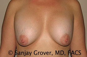Breast Revision Before and After | Grover Aesthetics