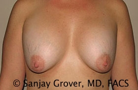 Breast Revision Before and After 45 | Sanjay Grover MD FACS