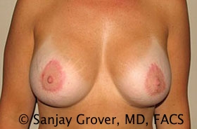 Breast Revision Before and After | Grover Aesthetics