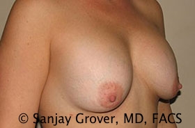 Breast Revision Before and After 37 | Grover Aesthetics