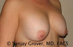 Breast Revision Before and After 37 | Sanjay Grover MD FACS