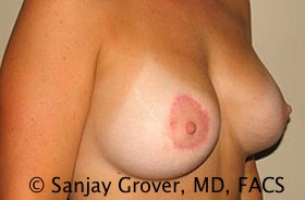 Breast Revision Before and After 37 | Grover Aesthetics