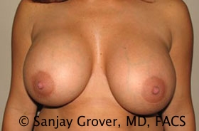 Breast Revision Before and After | Grover Aesthetics