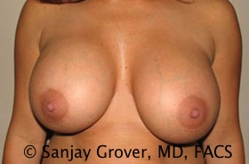 Breast Revision Before and After 30 | Sanjay Grover MD FACS