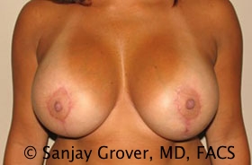 Breast Revision Before and After | Grover Aesthetics