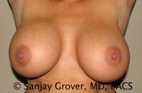 Breast Revision Before and After 38 | Grover Aesthetics