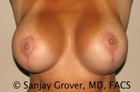 Breast Revision Before and After 38 | Grover Aesthetics